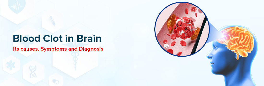 Blood Clot in Brain, Its Causes, Symptoms and Diagnosis